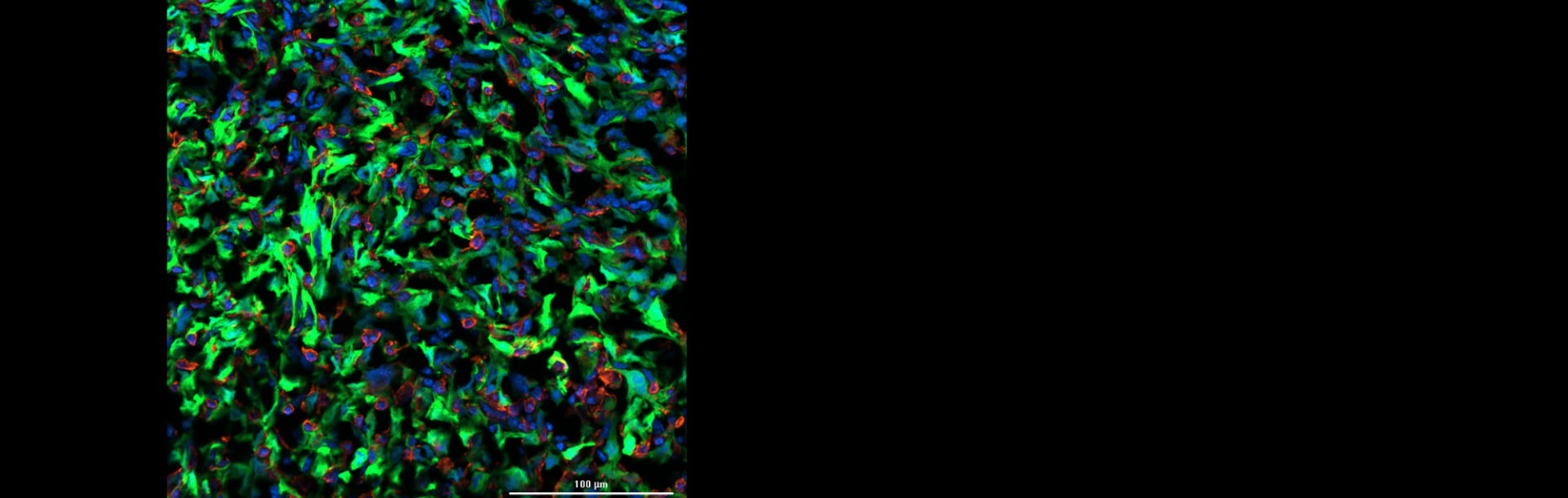 פריצת דרך בפענוח המנגנון שמאפשר לסרטן השד לשלוח גרורות למוח