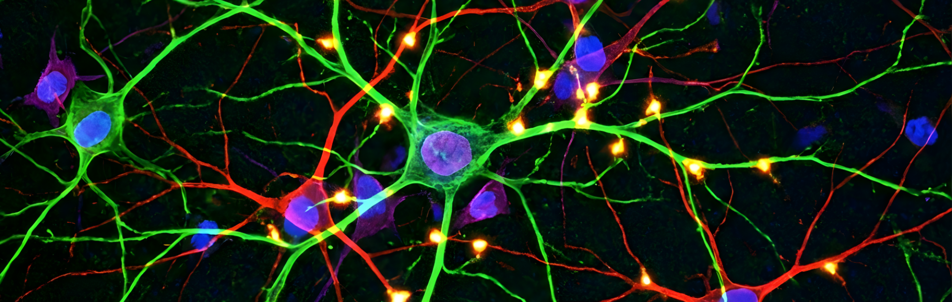 מנגנון חדש עשוי להאט את מחלת הנטינגטון