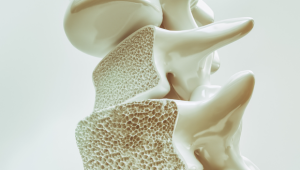Genetic implications for teriparatide use in osteoporosis therapy