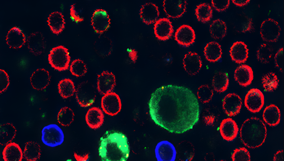 גילוי פורץ דרך חושף כיצד סרטן תוקף את מערכת החיסון