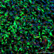 פריצת דרך בפענוח המנגנון שמאפשר לסרטן השד לשלוח גרורות למוח